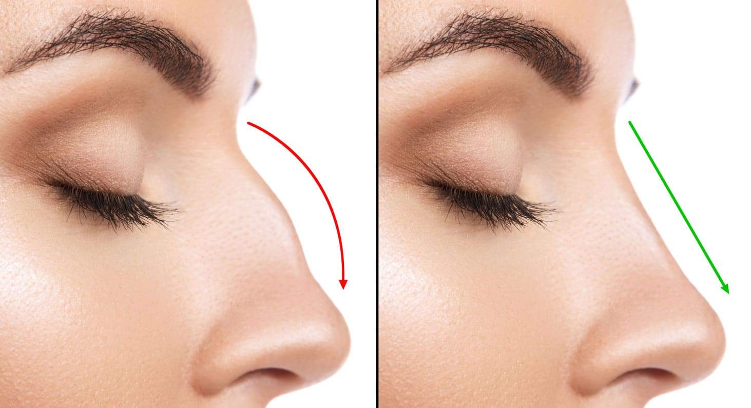 Rhinoplasty Packages (Nose Job)
